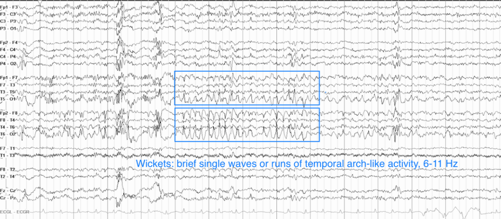 Protocolo de interpretación del EEG en epilepsia pediátrica ...